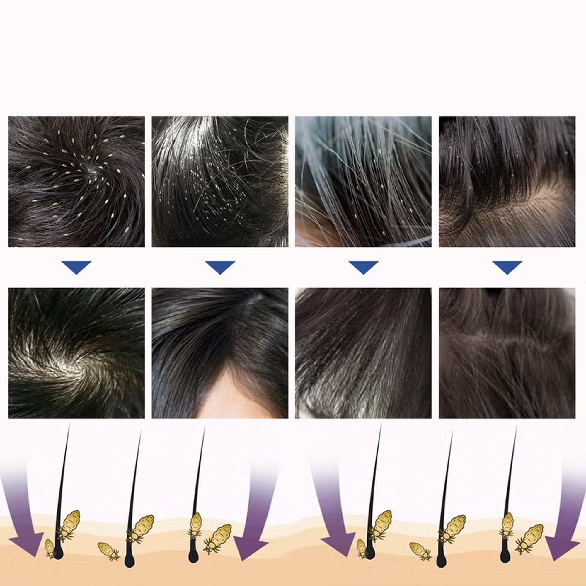 بخاخ علاج فعال للقمل امن للاطفال والكبار الصورة 3