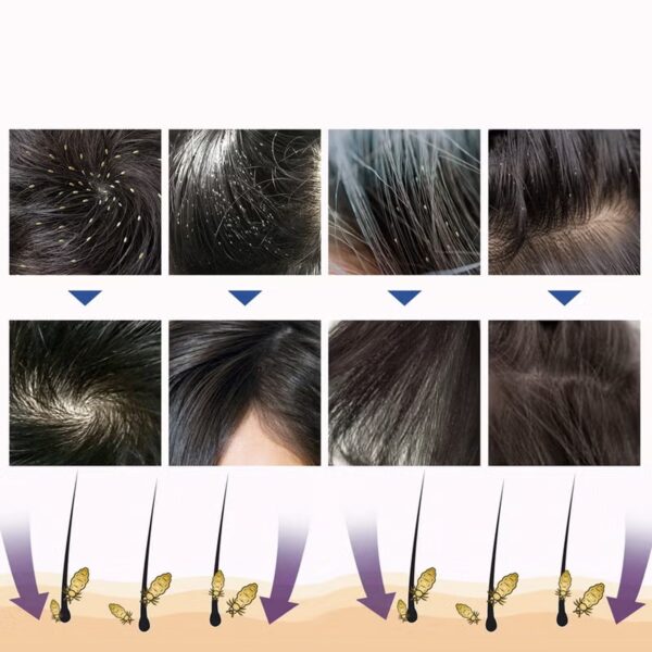 مشط إزالة القمل الكهربائي+بخاخ علاج فعال للقمل امن للاطفال والكبار